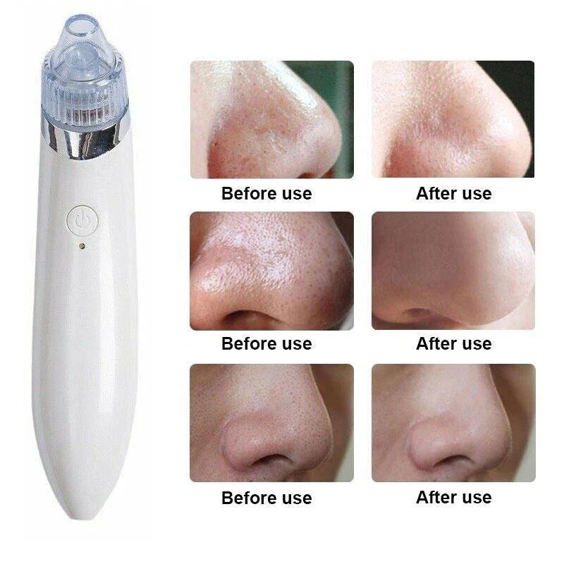 Blackhead Remover Vacuum Acne Cleaner – Deep Pore Cleansing for Flawless Skin